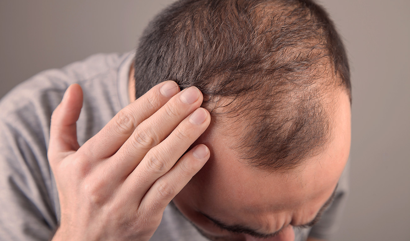 Queda de cabelo ligada a remédios emagrecedores preocupa especialistas; entenda
