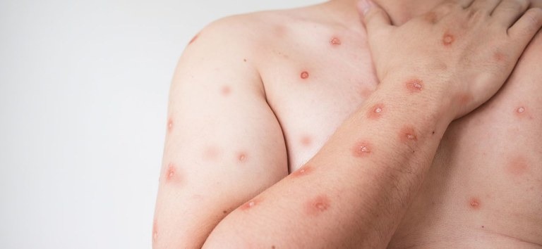 mpox